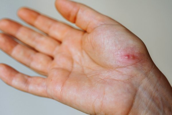 Eczéma des mains : comprendre et soulager les symptômes